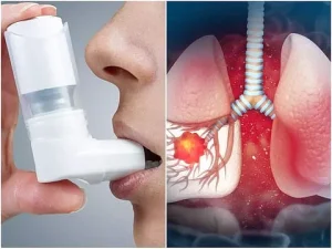 ছবিতে একজন ব্যক্তিকে ইনহেলার ব্যবহার করতে এবং পাশে ফুসফুসের ভেতরের বায়ুপথের প্রদাহের একটি ইলাস্ট্রেশন দেখা যাচ্ছে।