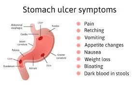 এই ইনফোগ্রাফিকটিতে পাকস্থলীর আলসারের বিভিন্ন লক্ষণ দেখানো হয়েছে, যার মধ্যে পেট ব্যথা, বমি ভাব, ক্ষুধামন্দা, ওজন কমে যাওয়া এবং মলের সাথে রক্ত যাওয়ার মতো গুরুত্বপূর্ণ উপসর্গগুলো তালিকাভুক্ত করা হয়েছে।