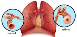 একটি ইলাস্ট্রেশন যেখানে সুস্থ ফুসফুসের স্বাভাবিক বায়ুপথ এবং অ্যাজমা আক্রান্ত ফুসফুসের সংকুচিত ও প্রদাহযুক্ত বায়ুপথের পার্থক্য দেখানো হয়েছে।