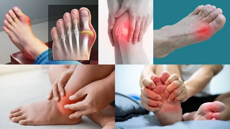 পায়ের বিভিন্ন জয়েন্টে ব্যথা এবং ইউরিক অ্যাসিডের লক্ষণ।