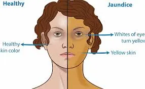 একটি ছবি যেখানে সুস্থ মানুষের ত্বক এবং জন্ডিসে আক্রান্ত ব্যক্তির হলুদ হয়ে যাওয়া ত্বক ও চোখের মণির পার্থক্য দেখানো হয়েছে।
