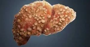 সিরোসিসে আক্রান্ত একটি মানব যকৃতের ত্রিমাত্রিক চিত্র।