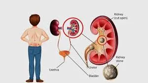 মানুষের কিডনি পাথর এবং মূত্রতন্ত্রের বিভিন্ন অংশ প্রদর্শনকারী একটি শিক্ষামূলক চিত্র।