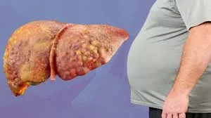 একটি অসুস্থ লিভারের চিত্র এবং পেটের অতিরিক্ত মেদযুক্ত একজন ব্যক্তি।