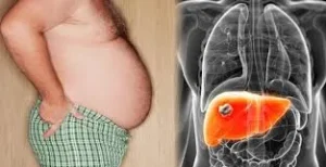 একজন স্থূলকায় ব্যক্তির পেট এবং শরীরের ভেতরে লিভারের সমস্যার একটি ডায়াগ্রাম।