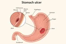 পাকস্থলীর আলসারের একটি সচিত্র উপস্থাপনা, যেখানে পাকস্থলীর ভেতরের দেওয়ালের বিভিন্ন স্তর এবং ক্ষতের অবস্থান চিহ্নিত করা হয়েছে।