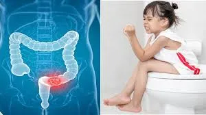 কোষ্ঠকাঠিন্যে আক্রান্ত একটি শিশু এবং মানুষের বৃহদন্ত্রের একটি শারীরস্থানিক চিত্র।