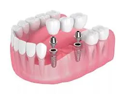 Dental Crowns & Bridges