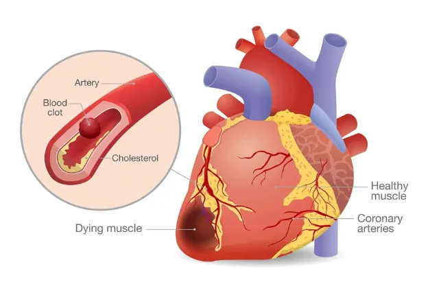 A medical diagram showing a blood clot and cholesterol buildup in a coronary artery leading to dying heart muscle.