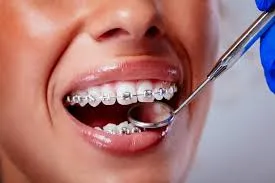 Orthodontics (Braces)