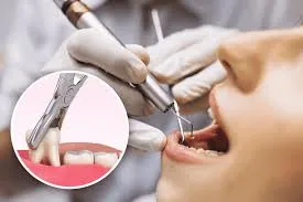 Painless Tooth Extraction