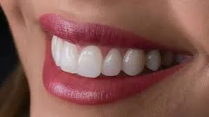 Smile Designing / Veneers