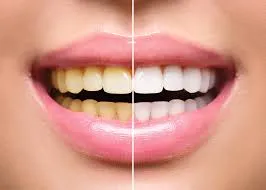 Teeth Whitening
