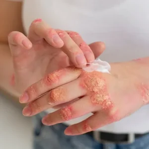A close-up of a patient applying white medical cream to red, scaly psoriasis patches on their hands.
