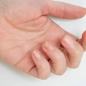 A close-up view of a hand with fingernails showing signs of yellowing and brittleness from a fungal infection.