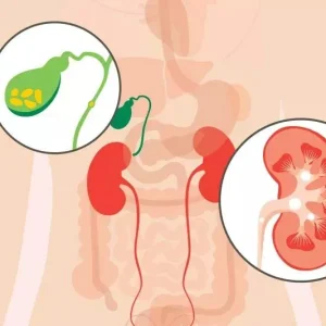 An anatomical illustration showing the gallbladder with yellow gallstones and a kidney with white kidney stones within the human body.