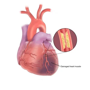 A medical diagram of a human heart with an inset showing plaque buildup in an artery and labeled damaged muscle.