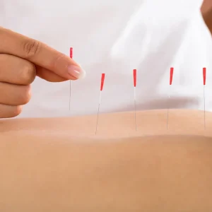 A close-up showing a practitioner's hand inserting a thin acupuncture needle with a red handle into a patient's back, with several other needles already in place.