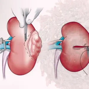A two-part surgical illustration showing a scalpel removing a tumor from a kidney and the subsequent suturing of the incision site.